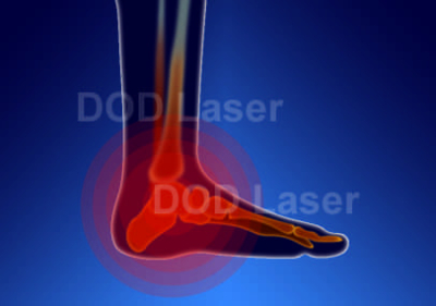 Ankle sprain