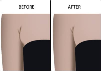 Bra Fat Removal