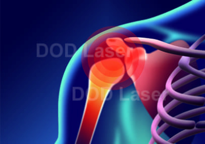 Scapulohumeral periarthritis