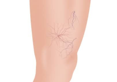 Spider Veins Removal