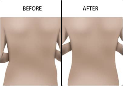 Abdominal Fat Removal