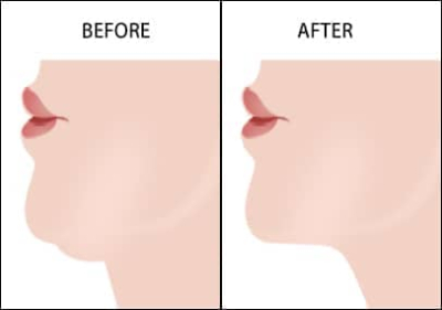 Double Chin Removal