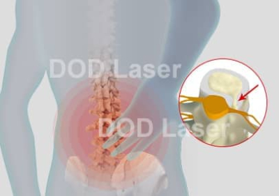 Percutaneous Laser Disc Decompression (PLDD)