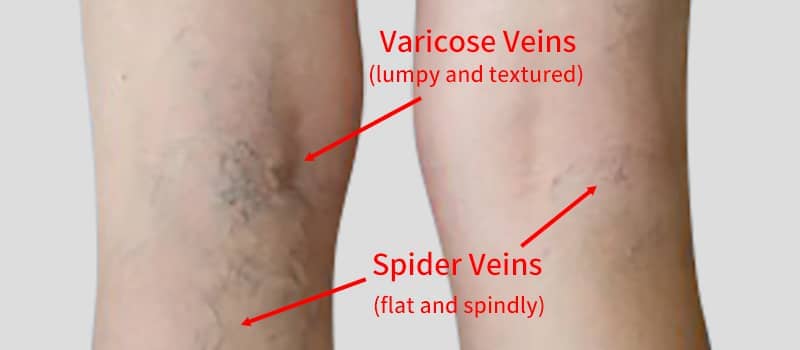 vascular veins